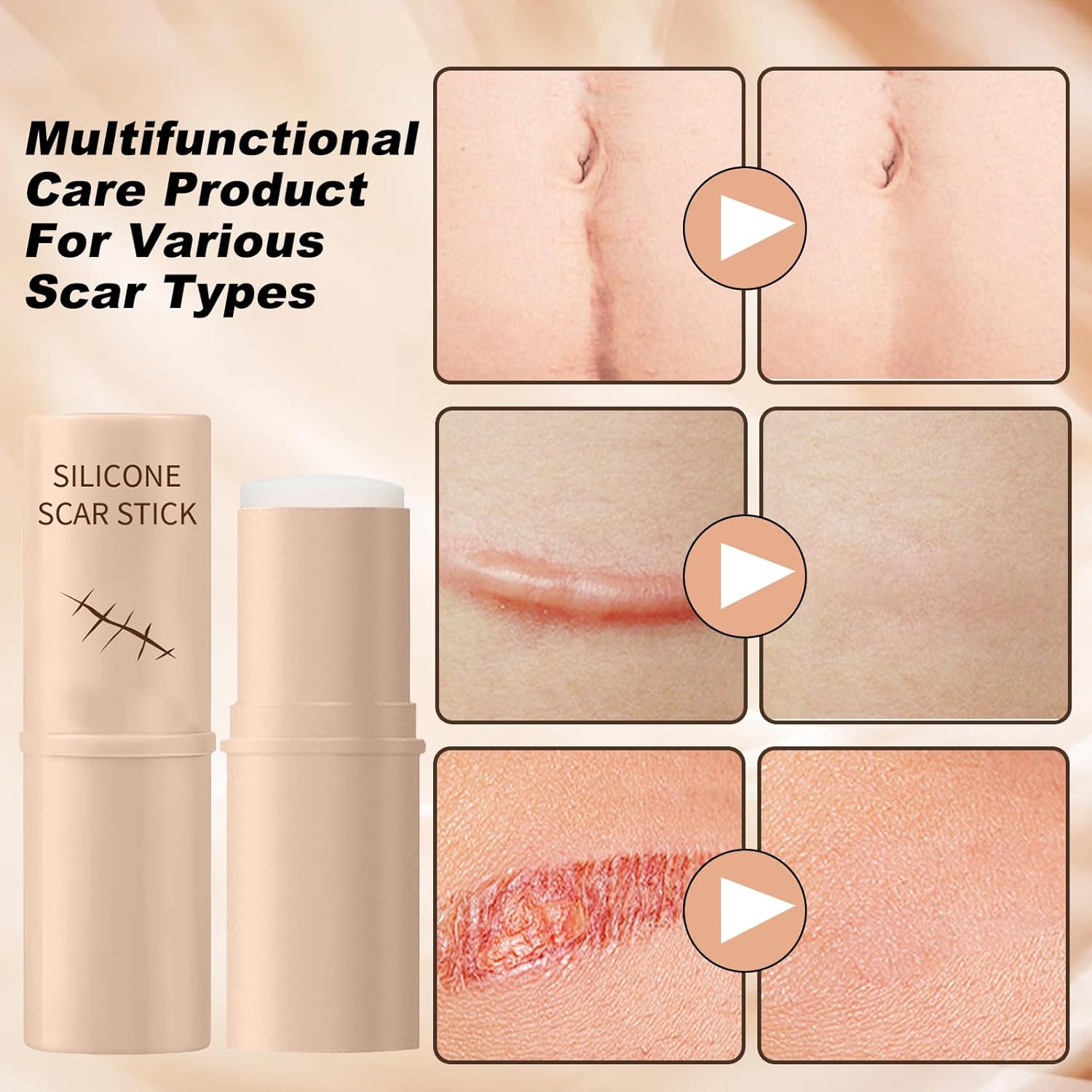 QuikRelief™ Silicone Scar Repair Stick